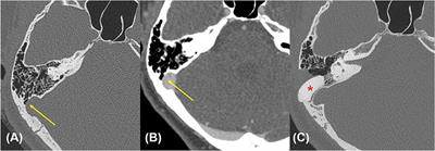 Preoperative Significance of Ipsilateral Manual Neck Compression in Patients With Pulsatile Tinnitus Secondary to Sigmoid Sinus Dehiscences and Diverticula